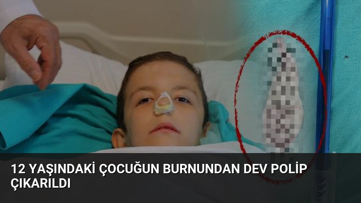 12 Yaşındaki Çocuğun Burnundan Dev Polip Çıkarıldı