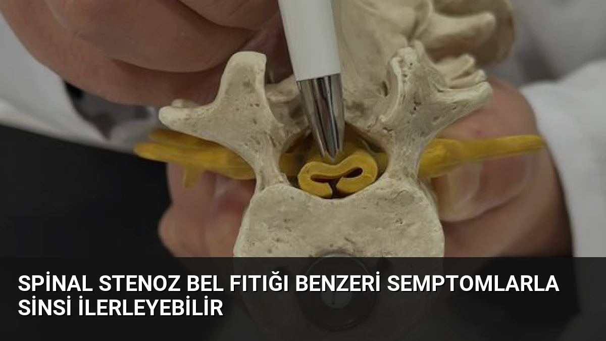 Spinal Stenoz Bel Fıtığı Benzeri Semptomlarla Sinsi İlerleyebilir