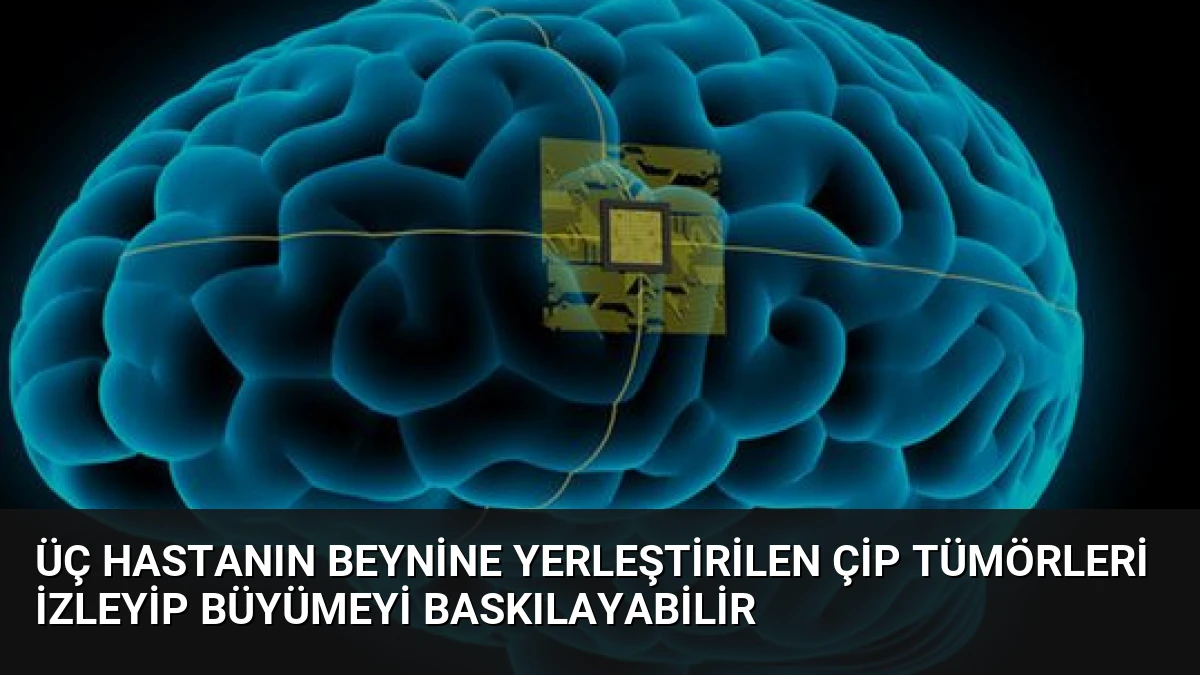 Üç Hastanın Beynine Yerleştirilen Çip Tümörleri İzleyip Büyümeyi Baskılayabilir